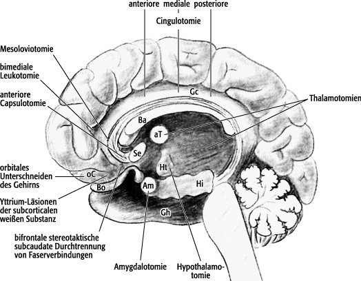 Psychochirurgie - Lexikon Der Neurowissenschaft