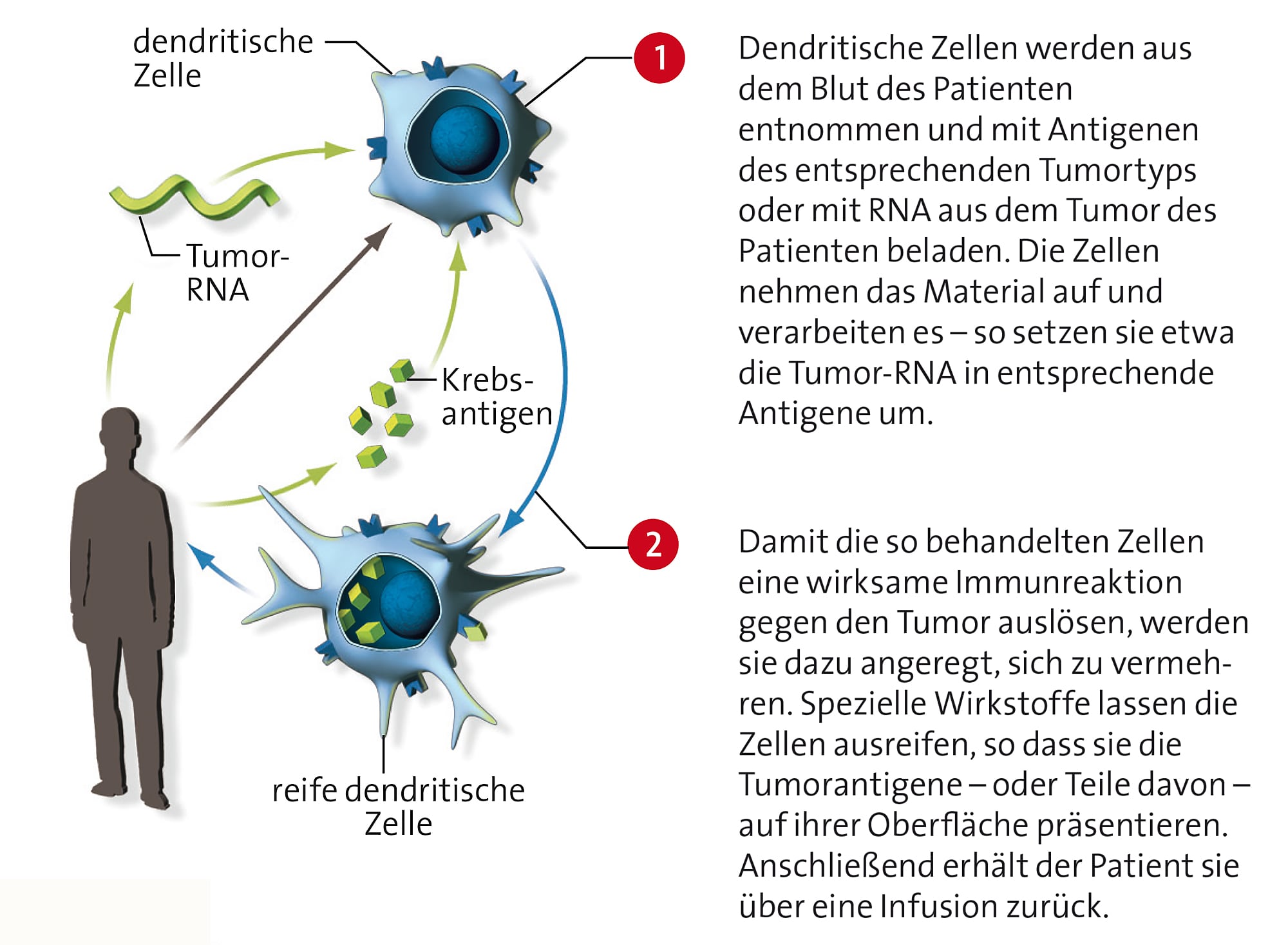 Tumor-Immuntherapie: Patient Im Selbstversuch - Spektrum Der Wissenschaft